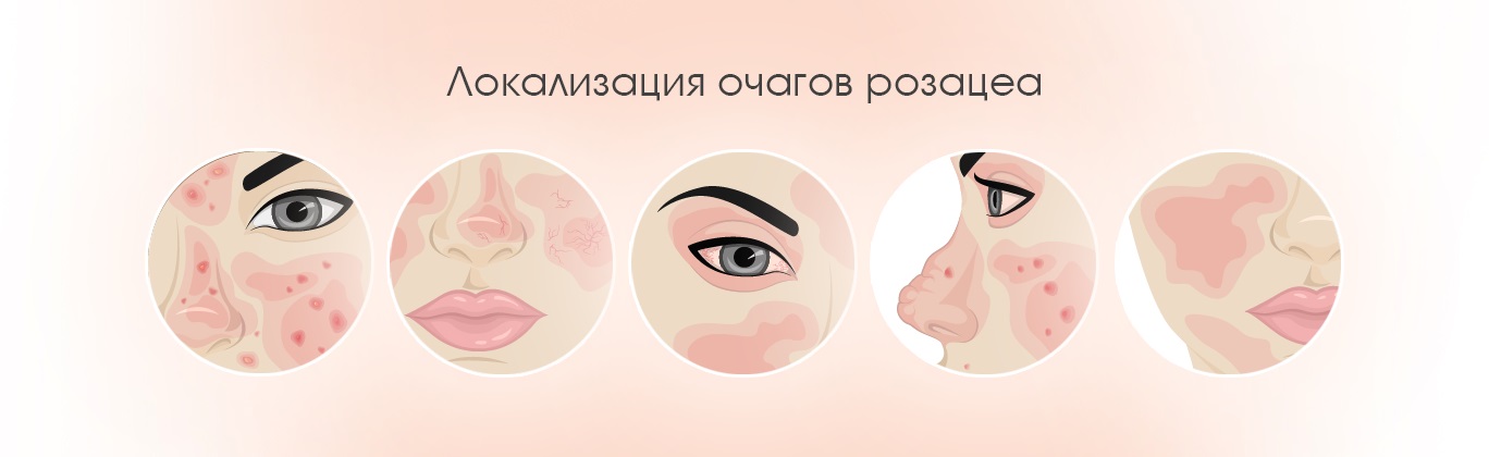 Розацеа