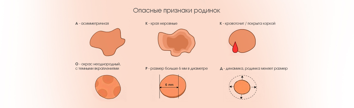 Основные признаки родинок