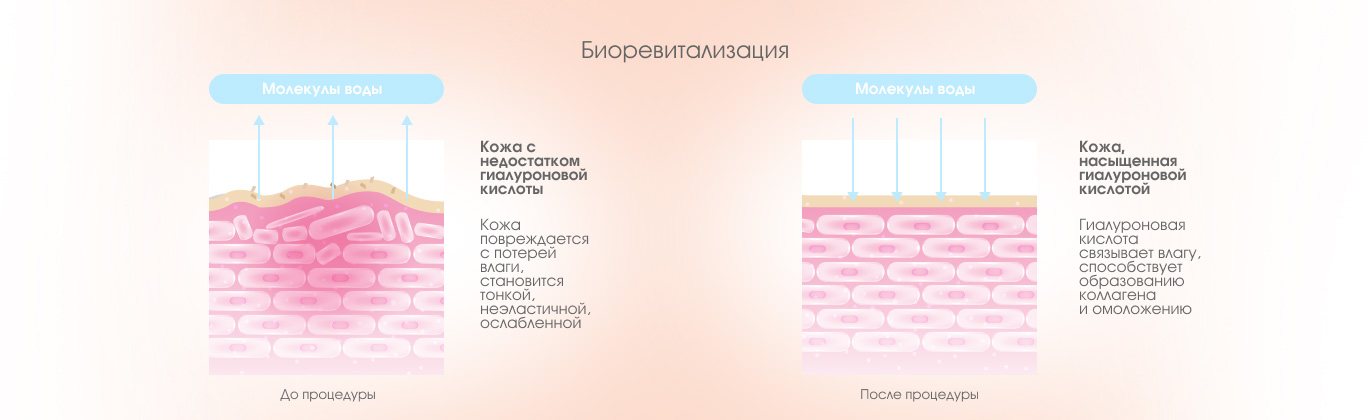 Биоревитализация