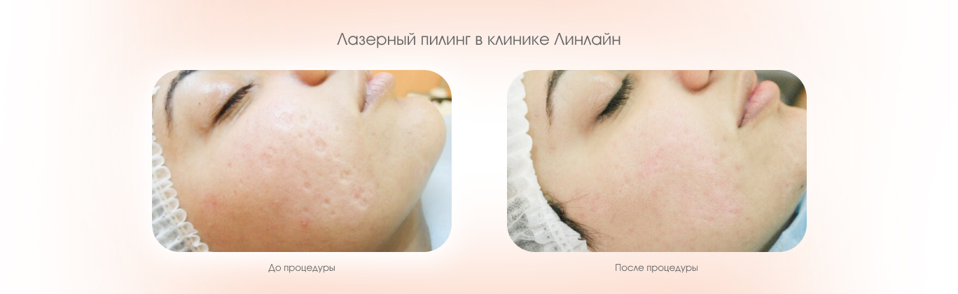 Аппаратные пилинги