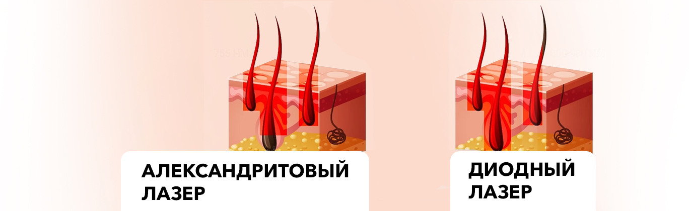 Диодный лазер