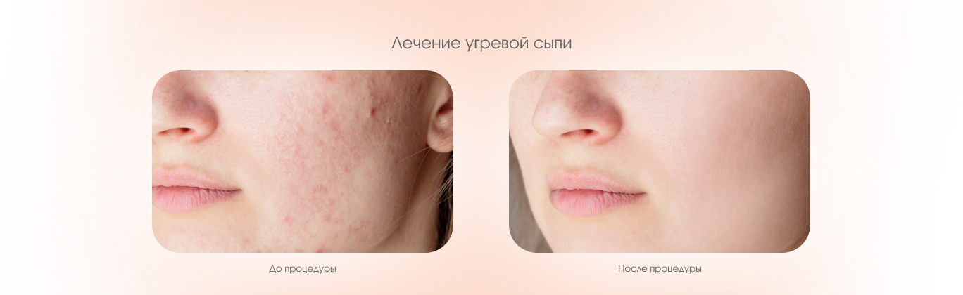 Лечение угревой сыпи