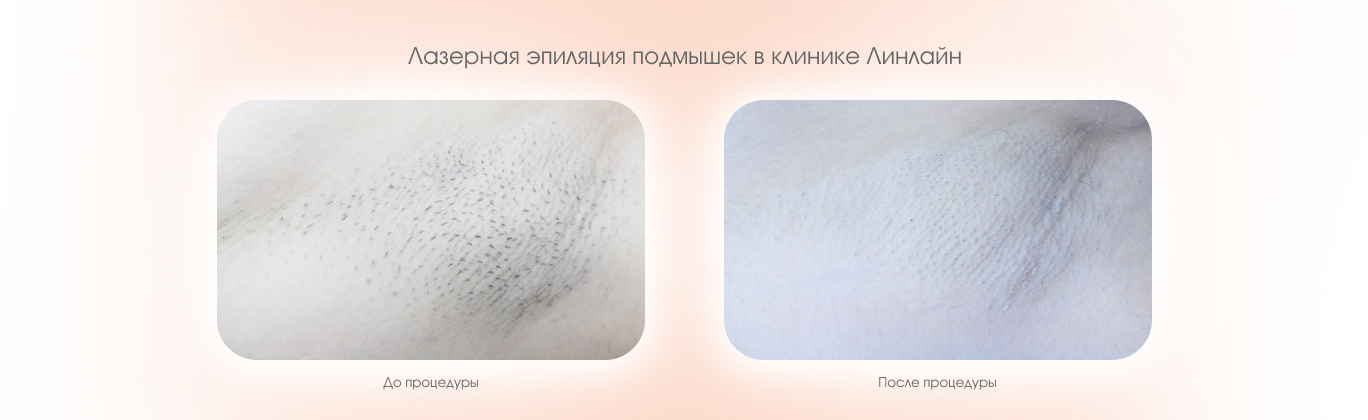 Лазерная эпиляция