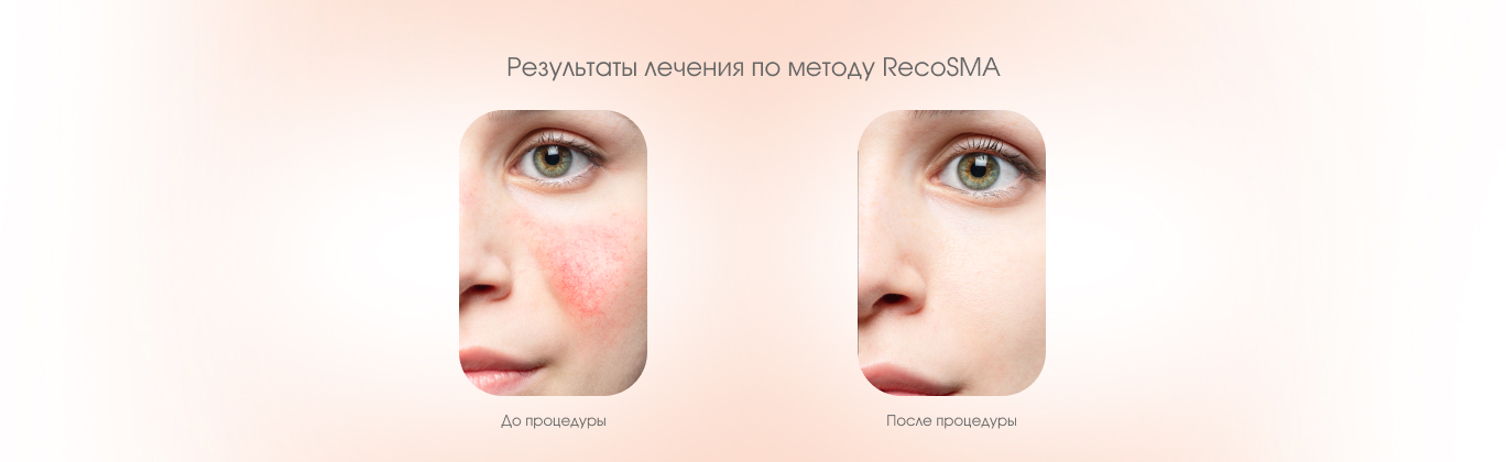 RecoSMA