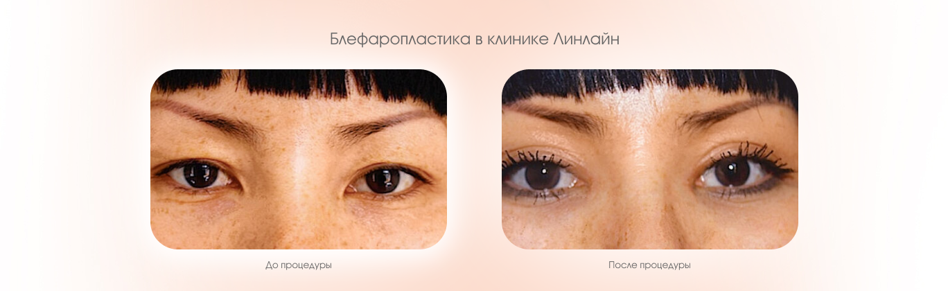 Блефаропластика