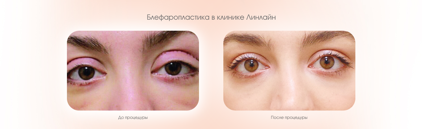 Блефаропластика