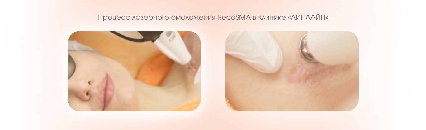 RecoSMA