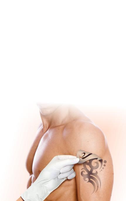 Лазерное удаление татуировок
