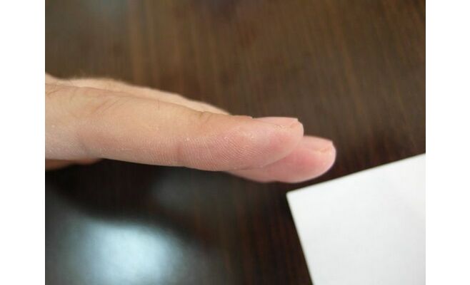 Лазерное удаление новообразований на пальцах рук