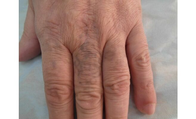 Лазерное удаление татуировок на пальцах
