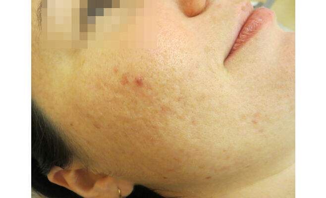 Лазерное лечение угревой сыпи на лице