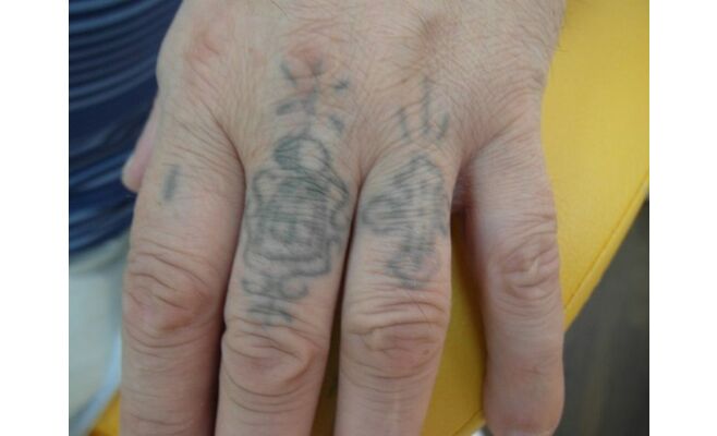Лазерное удаление татуировок на пальцах