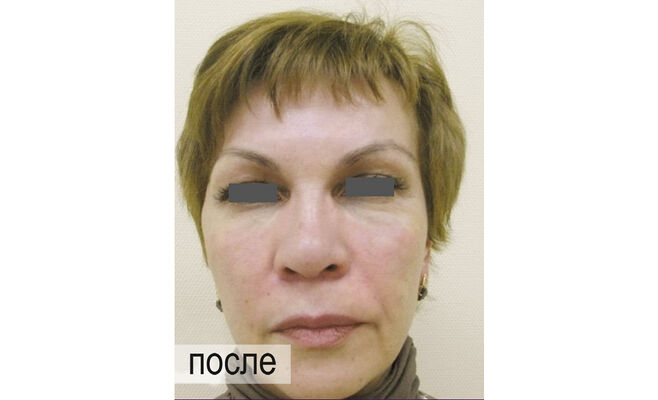 Удаление морщин вокруг глаз после процедуры