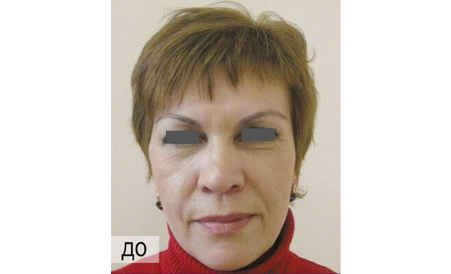 Удаление морщин вокруг глаз до процедуры