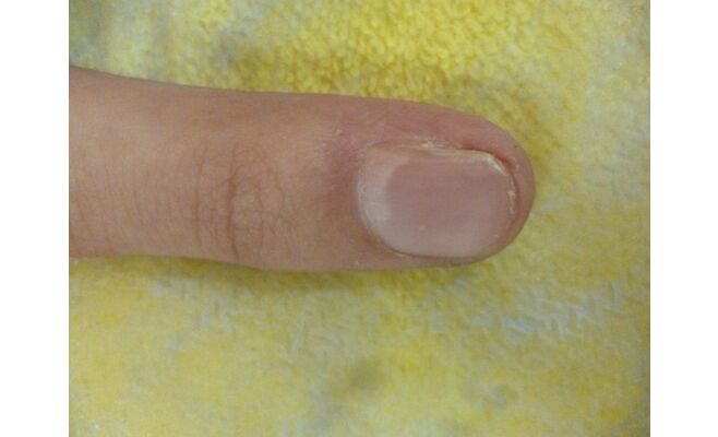 Лазерное удаление новообразований на пальцах рук после процедуры