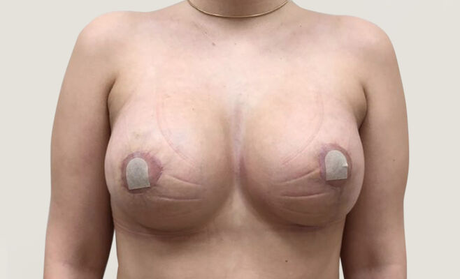 Увеличение груди и коррекция асимметрии после процедуры