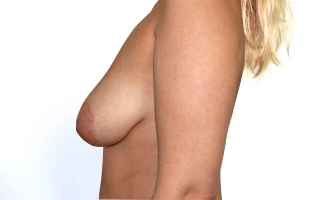 Увеличение груди и коррекция асимметрии до процедуры