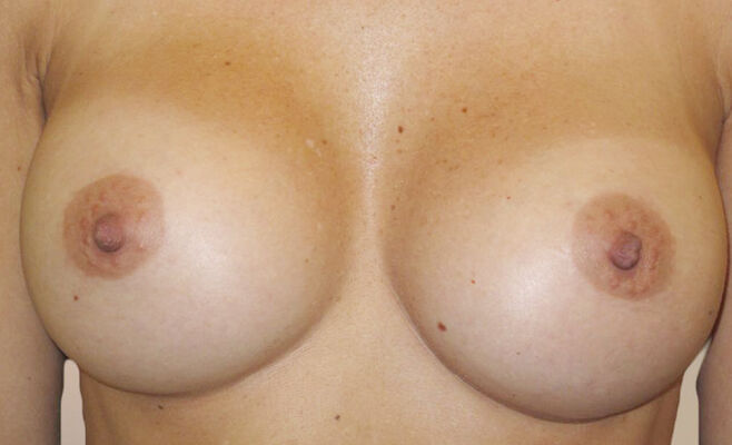 Гулянский. Увеличение груди после процедуры