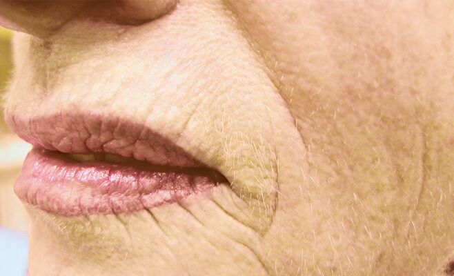 RecoSMA: коррекция кисетных морщин над верхней губой