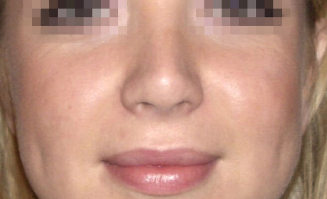 Ринопластика широкого носа после процедуры