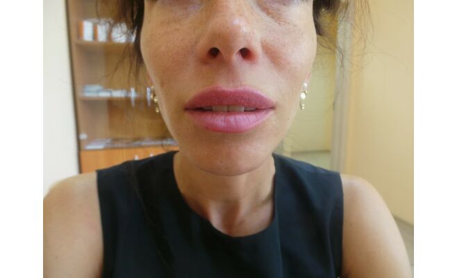 Увеличение губ после процедуры