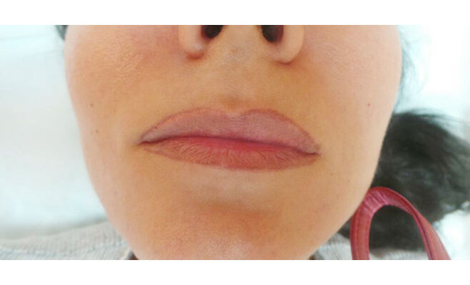 Удаление перманентного макияжа губ
