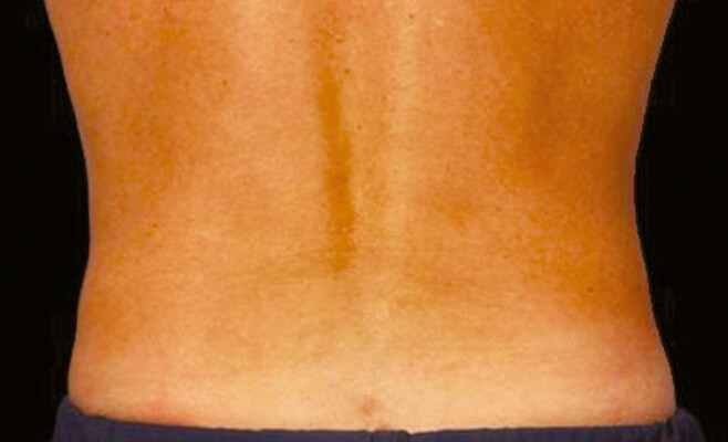 CoolSculpting-тело