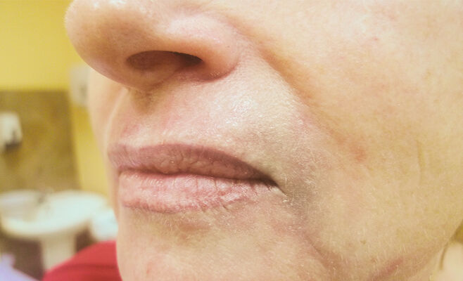 RecoSMA: коррекция кисетных морщин над верхней губой