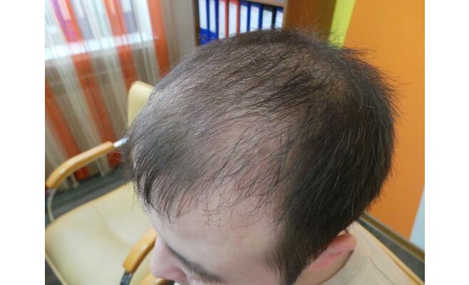 Пересадка волос на лобную область после процедуры