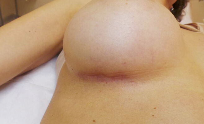 Удаление рубцов после увеличения груди до процедуры