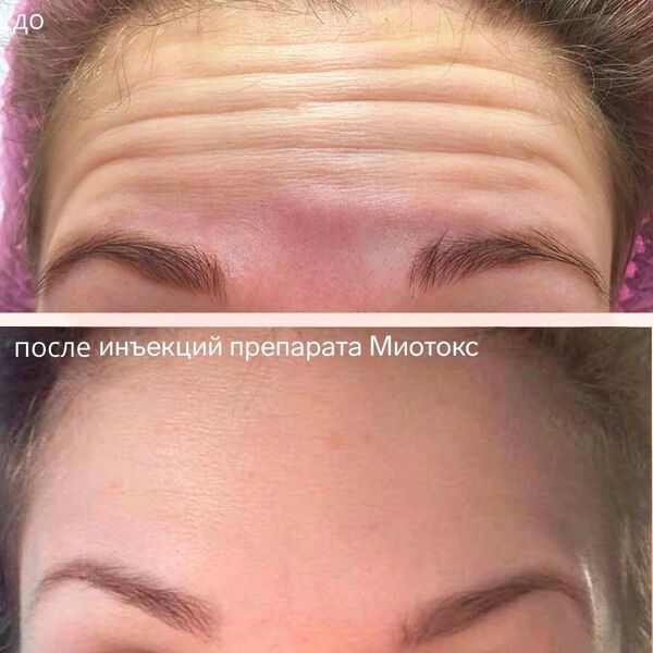 До-после Миотокс.jpg