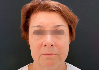 РФ-лифтинг