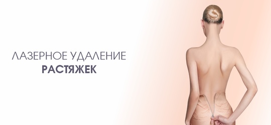 Лазерное удаление растяжек