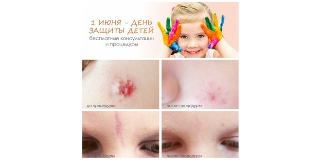 Акция Линлайн